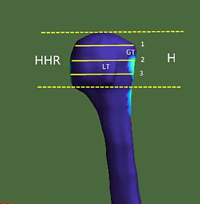 Menopause-related cortical loss of the humeral head region mainly occurred in the greater tuberosity